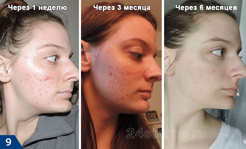 Третиноином от прыщей Третиноином от прыщей