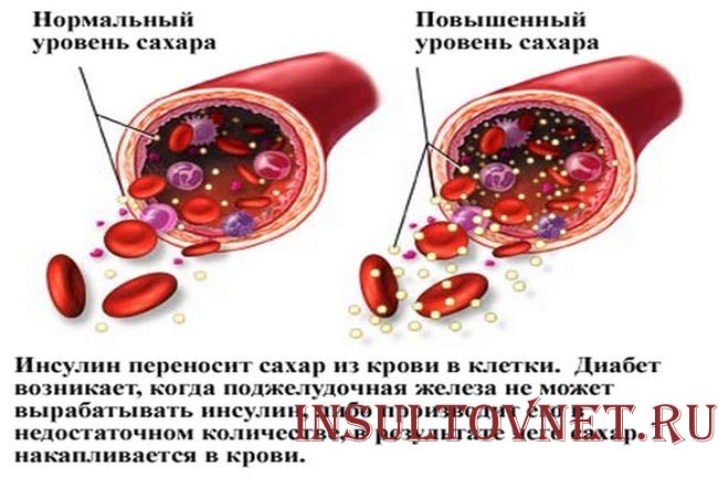 Высокое содержание сахара в крови как лечить Высокое содержание сахара в крови как лечить