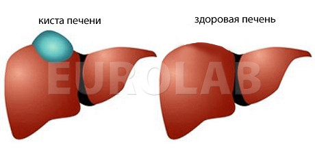 Как лечить народными средствами кисты на печени Как лечить народными средствами кисты на печени