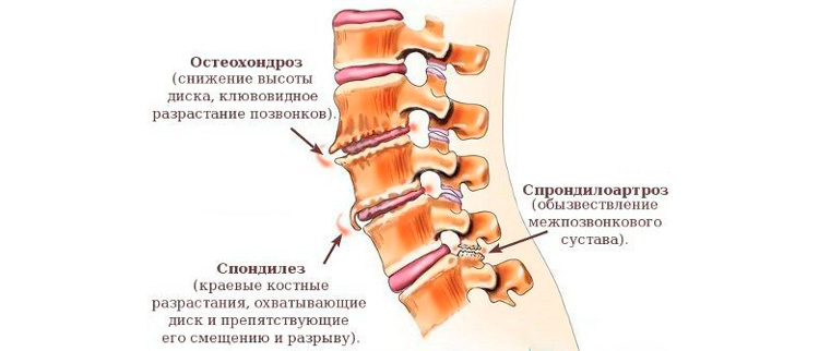 Боль в тазобедренном суставе причины, симптомы, диагностика и Боль в тазобедренном суставе отдающая в пах