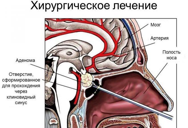 Лечение простатита методы и схемы Лечение аденомы простаты