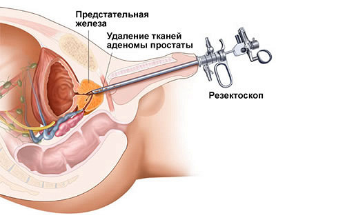 Как лечить скорострельность в домашних условиях Как лечить скорострельность в домашних условиях