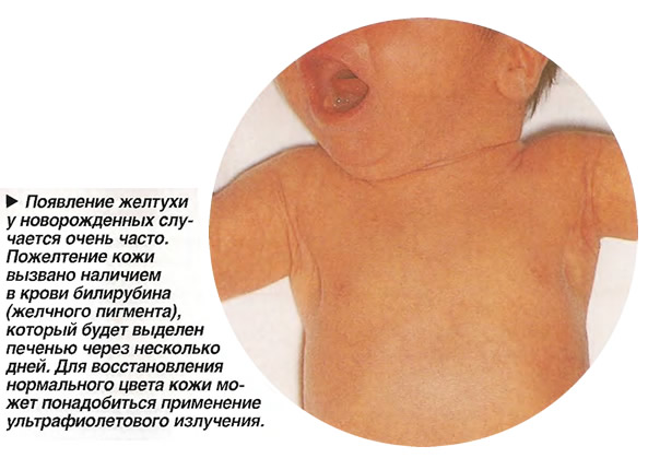 Желтуха домашних условиях