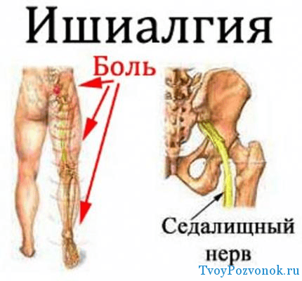 Боль в ягодице справа отдающая в ногу как лечить Боль в ягодице справа отдающая в ногу как лечить