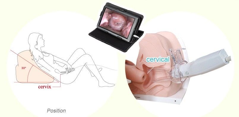Видео камера в гинекологии видео