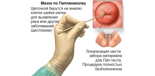 Вирус папилломы человека у женщин гинекология лечение